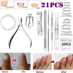 Nail Infection, Fungal Nail, Pure Aloe Vera, Cheap Nail, Dry Skin Patches, Ingrown Toe Nail, Toenail Fungus, Facial Spa, Skin Remedies