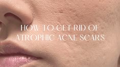 If you need effective and realistic ways of how to get rid of atrophic acne scars at home, don't miss out on these 5 options for smooth skin! Best Acne Scar Removal, Before And After Acne, Getting Rid Of Scars, Acne Scaring, Facial Scars, Acne Face Mask, Acne Scar, Acne Scar Removal, Face Acne