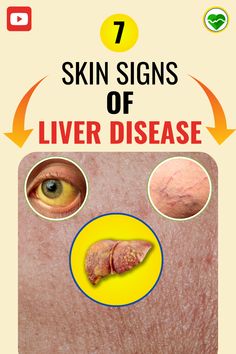 our skin could be sending distress signals from your liver. Decode them here and find out what your skin tells about your liver health. #LiverHealth #LiverCare #HealthyLiver #LiverWellness #LiverDisease #LiverSupport  #LiverDetox #liverhealth #liver #health Sluggish Liver Symptoms, End Stage Liver Failure, Liver Issues, Liver Support, Women Health