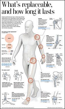 As joint replacements grow more popular, younger patients face repeat surgeries Knee Replacement, Anatomy And Physiology, Human Anatomy, Massage Therapy, Physical Therapy