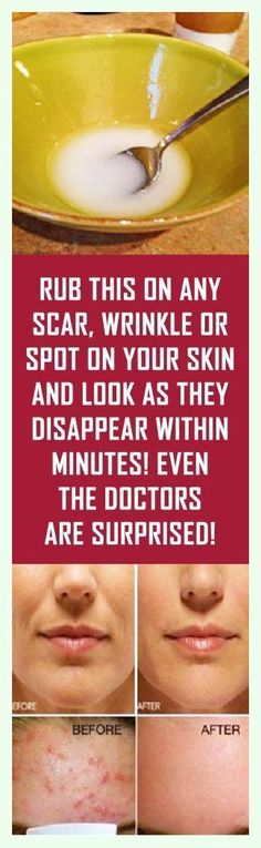 Thanks a million. Super-duper advice! Beauty Remedies, Skin Remedies, Skin Care Acne, Beauty Treatments, Health Remedies, Facial Skin, Skin Treatments, Moisturizer Cream, Home Remedies