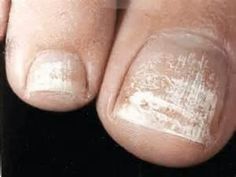 Many of our clients already know what this is but for those that don’t here’s the lowdown! If after removing your toenail polish, you see these white chalky patches then  in most cases it is a condition called keratin granulation. These occur from constant polish wearing. This is not a fungus but can look much like it and can trigger a fungus so it is important to treat it. Keratin granulations occur because the polish dries out the surface of the nail. When the nail surface gets this dry it ... White Patches On Toenails, White Spots On Toenails, White Spots On Nails, Nail Discoloration, Toenail Fungus Remedies, Nail Care Tips, Toenail Polish, Ingrown Toe Nail, Toenail Fungus