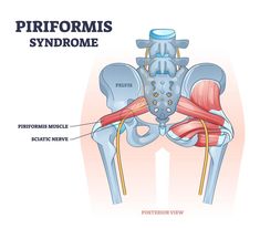 Piriformis Syndrome: 7 Tips to Get FAST Relief (No Exercises or Stretches) Hata Yoga, Nerve Problems, Tension Release, Hip Mobility Exercises, Hip Opening Yoga