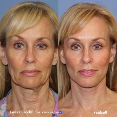 Lower Face And Neck Lift, Lower Facelift Before And After, Before And After Face Lift, Vertical Restore Facelift, Thread Lift Face Before And After, Lower Blephoraplasty Before And After, Neck Lift Before And After, Cheekbone Filler Before And After