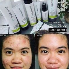 Https://Www.Marykay.Com/Mrs.Ewalker Marykay Skincare Sets, Before And After Acne, Clearproof Mary Kay, Selling Mary Kay, Imagenes Mary Kay, Mary Kay Skin Care, Mary Kay Consultant, Advanced Skin Care, Mary Kay Ideas