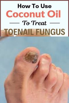 Toenail fungus is destructive to your nails and more common than you think! After trying several over the counter remedies that failed, I turned to natural remedies and finally got rid of my toe nail fungus.#fungusproblem #killsnail #treatmentfungus #nailfungus #toenailfungus #fungus #fungustretment #fungustoenail Antifungal Nail Polish, Homemade Oils, Homemade Oil