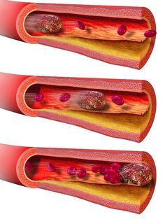 Difference Between Blood Clot and Miscarriage Intravenous Injection, Intravenous Therapy, Amniotic Fluid, Arteries And Veins, Bone Fracture, Excessive Sweating, Circulatory System, Blood Vessels, Blood Flow