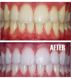 Put a tiny bit of toothpaste into a small cup, mix in one teaspoon baking soda plus one teaspoon of hydrogen peroxide, and half a teaspoon water. Thoroughly mix then brush your teeth for two minutes. Remember to do it once a week until you have reached the results you want. Once your teeth are good and white, limit yourself to using the whitening treatment once every month or two. - Click image to find more DIY & Crafts Pinterest pins Tooth Whitening, Diy Kosmetik, Brush Your Teeth, Periodontal Disease, Oil Pulling, Hydrogen Peroxide