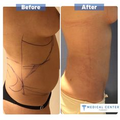 #istanbul #plasticsurgery #beforeafter #beforeandafter #beforeafterpics #liposuctionbeforeafter #before #after #medicalcenterturkey #pinterest #pinterestinspired #liposuction #fats #fatremoval #fatremovalchin #fatremovalbelly #fatremovallegs #fatremovalface #fatremovalneck #slimface #women #men Botox Injection Sites, Composite Veneers, Rhinoplasty Surgery, Botox Injections, Medical Tourism, Best Doctors, Dental Services, Hair Transplant, Medical Center