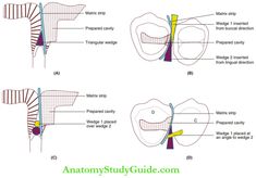 Isolation Matricing And Wedging Notes - Anatomy Study Guide Nasal Obstruction, Parotid Gland, Best Contouring Products, Spot Welder, Restorative Dentistry, Medical School Essentials