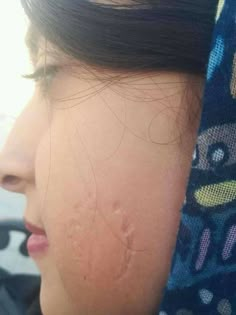 a close up of a woman's head with acne on her face and neck