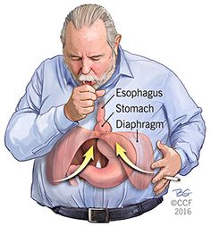 Hiatal Hernias In Women Symptoms, Esophagus Problems, Vegas Nerve, Hiatal Hernias, Esophageal Spasm, Anatomy Pictures, Hemorrhoid Remedies, Hemorrhoid Relief, Digestive Problems