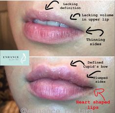 Cupids Bow Lips, Face Plastic Surgery, Upper Lip Hair