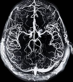 an x - ray image of the inside of a human brain