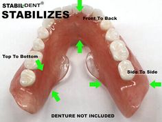 Diy Dentures, Dental Impression Material, Denture Adhesives, Denture Repairs, Affordable Dentures, Tooth Pulled, Temporary Tooth, Denture Adhesive, Denture Implants