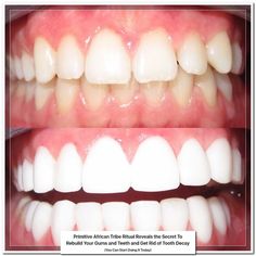 Baking Soda and Lemon for Teeth Whitening Baking Soda For Teeth, Coconut Oil And Baking Soda, Zoom Teeth Whitening, Dental Advertising, Dearborn Michigan, Botox Cosmetic, Baking Soda And Lemon