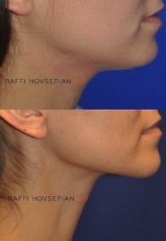 Plastic Surgery Jawline, Double Chin Lipo Before And After, Neck Lipo Before And After, Chin Lipo Before And After, Jawline Surgery, Jawline Sculpting, Double Chin Surgery, Jaw Reduction Surgery, Md Aesthetic