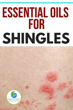 Shingles On Face, Oils For Shingles, Shingles Pain Relief, Shingles Remedies, Essential Oils For Shingles, Treating Shingles, Shingles Relief, Shingles Rash, Home Remedies For Skin