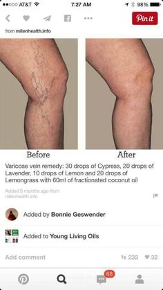 Essential Oil For Circulation, Varicose Veins Essential Oils, Varicose Vein Remedy, Doterra Essential Oils Recipes, Young Living Essential Oils Recipes, Essential Oils Guide