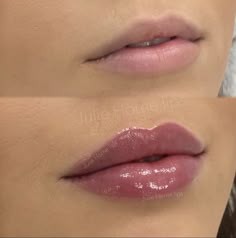 Lip Fillers Juvederm, Permanente Make-up, Face Fillers, Botox Lips, Drag Make-up, Facial Fillers, Facial Aesthetics