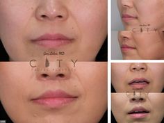 Lip Lift Before and After | New York Plastic Surgeon Dr. Linkov Facial Plastic, Scar Tissue, Before And After Pictures, After Photos, Plastic Surgeon, Medical Professionals, Surgery