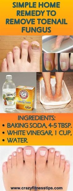 at home remedies for toenail fungus Toenail Fungus Remedies, Skinnytaste Recipes, Toenail Fungus, Skincare Video, Nail Fungus, Homemade Remedies, Simple Home, White Vinegar, Natural Home Remedies