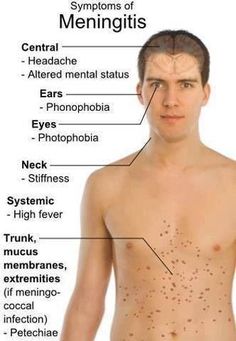 a man's chest with the names of meningitiss and their corresponding areas