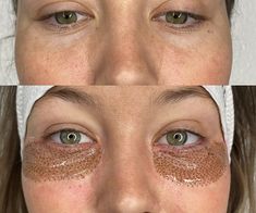 Fibroblast Before And After Eyes, Fibroblast Before And After, Plasma Facial, Fibroblast Plasma, Face Plastic Surgery, Plasma Pen, Gentle Face Wash, Skin Tightening Treatments, Facial Plastic Surgery