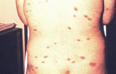 HIV rash: Types, other symptoms, changes Hiv Symptoms Men, Hiv Aids Symptoms, Skin Rashes Pictures, Signs Of Hiv, Aids Symptoms, Rash Causes, People With Hiv, Human Body Temperature