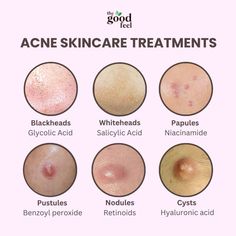 skin care 🔮 Acne Face Mapping Remedies, Active Acne Remedies, Dry And Acne Prone Skin, Fungal Acne Remedies, Breakout Map Face, Acne Breakout Chart, Face Problems Skin, Reasons For Acne On Face, Acne Around Mouth And Chin