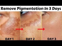 Hyper Pigmentation Skin Care Routine, Potato Face Mask, Removing Hyperpigmentation, Permanent Hair Removal Cream, Potato Face, Clear Skin Face Mask, Spotless Skin, Face Hair Removal