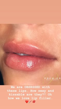 Natural Filler, Full Lips Makeup, Lip Model, Wedding Eyes, Aesthetic Dermatology, Lip Enhancement