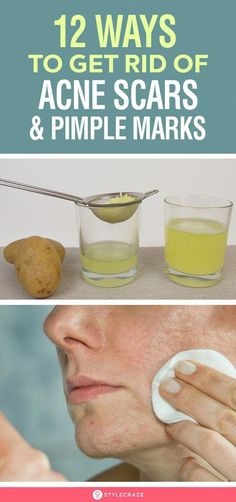 Natural remedies are an effective alternative to surgery or harsh techniques for treating acne scars. These 12 remedies can help lighten your scars gently. Pimple Solution, Scar Remedies, Pimples Under The Skin, How To Reduce Pimples, Acne Overnight, Pimple Scars, Diy Acne, Get Rid Of Acne, Rid Of Acne