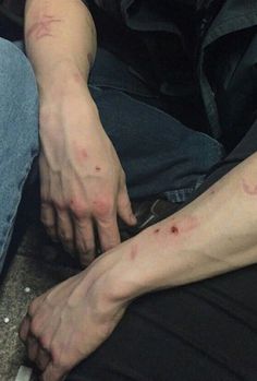 a man sitting on the ground with his foot covered in red dots and blood from an accident