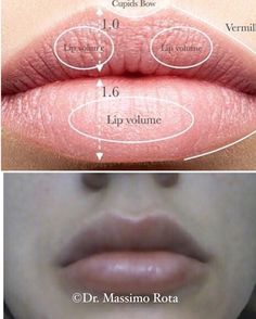 Lip Filler Technique, Dermal Fillers Lips, Line Lips, Juvederm Lips, Chin Filler, Hyaluronic Acid Fillers, Cosmetic Injectables, Lip Augmentation, Cranial Nerves