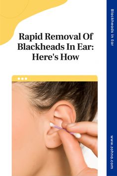 Blackheads in ear? Check out these recommendations for how to get rid of ear blackheads at home, prevent future outbreaks, and when to see a dermatologist. Ear Blackheads, Removal Of Blackheads, How To Treat Blackheads, Pimple Solution, Blackhead Remover Diy, Black Heads, Dark Eye Circles, Clean And Clear, Cold Sores Remedies