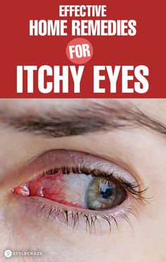 Itchy Eyes Remedy, Remedies For Itchy Eyes, Allergy Eyes, Irritated Eye, Itchy Eyes, Sore Eyes, Eyes Problems