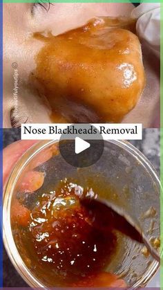 Baking Soda And Apple Cider Vinegar Face Mask, Best Mask For Blackheads, Diy Facemask Skincare Blackheads, Face Mask That Pulls Out Blackheads, How To Make Face Mask For Blackheads, Blackheads Mask Diy, Diy White Head Remover, Getting Rid Of Blackheads On Nose, Face Pack For Blackheads