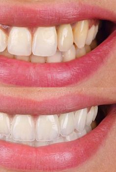 Teeth White Aesthetic, Esthetic Procedures, White Healthy Teeth Aesthetic, Teeth Aesthetic Smile, Hollywood Smile Veneers, Grow Back Receding Gums, Whiten Teeth Fast, Perfect Smile Teeth Porcelain Veneers, Dental Animation