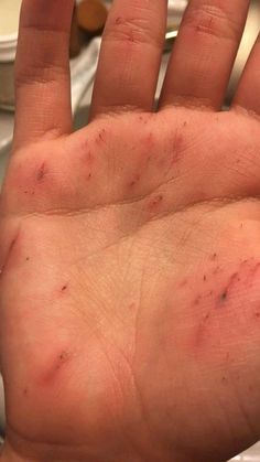 a hand that has some red spots on it