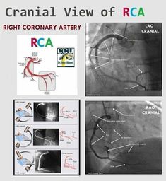 the cranial view of rca right coronary artery and radiographs