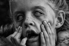 a black and white photo of a woman with freckled hair holding her hands to her face