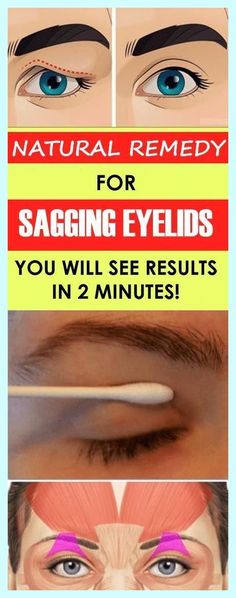 Saggy Eyelids, Sagging Eyelids, Lifting Facial, Medicine Book, Hooded Eyes, Homemade Remedies, Natural Remedy, Diy Health, Natural Treatments