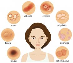 Diagram showing different skin condition... | Free Vector #Freepik #freevector #people #woman #medical #character Skin Diagram, Skin Types Chart, Lichen Planus, Skin Aesthetics, Plant Based Skincare, Skin Detox, Type Illustration, Acne Free, Skin Concern