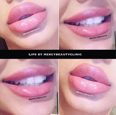 Lip Injections Juvederm, Juvederm Lips, Lip Surgery, Facial Contouring