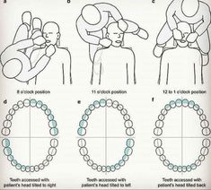 Coronal Polishing Dental