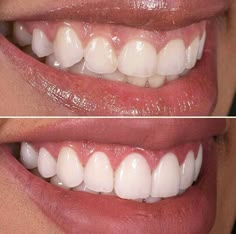 Whiten Teeth Fast, I Healed, Porcelain Veneers, Whiten Teeth, Before Going To Bed, Receding Gums, Tooth Decay, Cavities