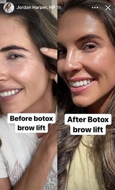 Eyebrow Botox Lift, Botox Eye Lift, Botox Eyebrow Lift, Botox For Hooded Eyelids, Eye Lift Surgery, Botox Brow Lift, Under Eye Fillers, Beauty Procedures