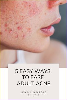 Learn 5 easy steps to ease adult acne. #holisticskincare #perimenopause #adultacne Holistic Skin Care, Acne Face Mask, Natural Acne, Congested Skin, Simple Skincare Routine, Essential Oils For Skin, Skincare Blog, Clear Skin Tips