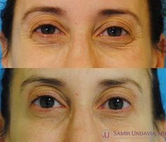 This 2 week before and after result for Botox shows lifted brows without crows feet when smiling. Lifted Brows, Crows